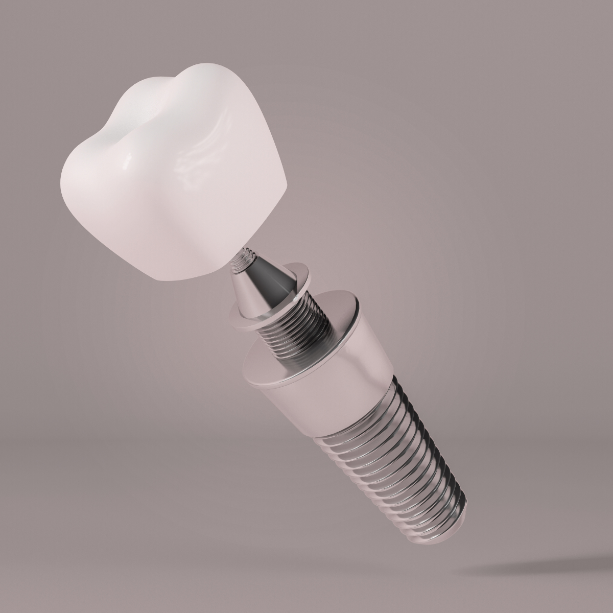 Dental Implant Price in Kandy