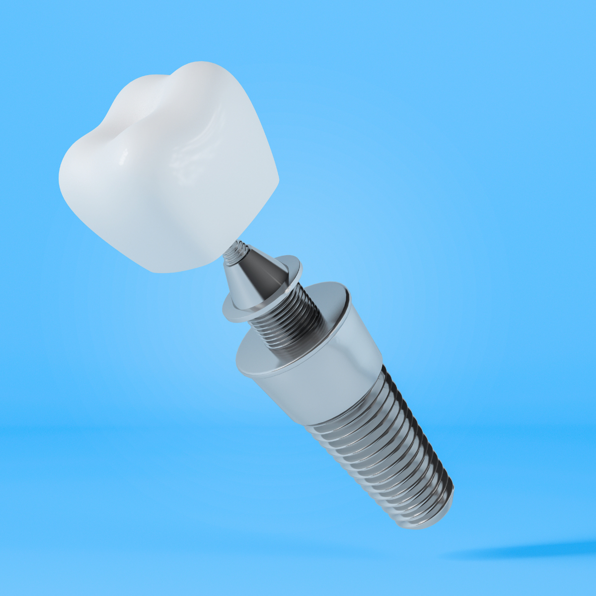 Dental Implant Prices in Sri lanka
