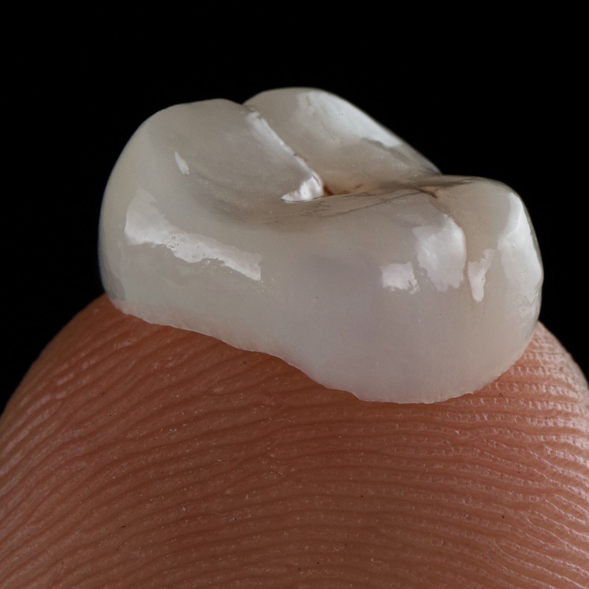 porcelain-crown-price-sri-lanka