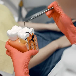 Root Canal Treatment (Molar Tooth)