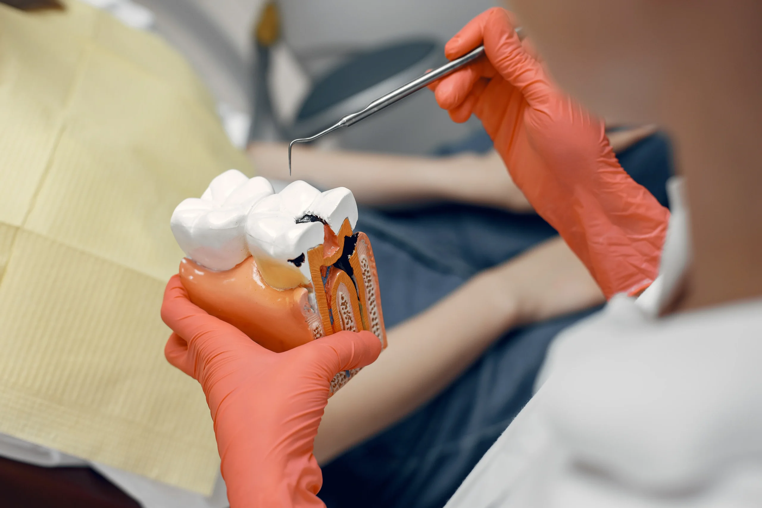 Root Canal Treatment (Molar Tooth)