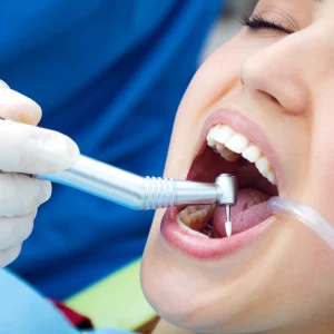 Teeth Cleaning Price in Sri Lanka