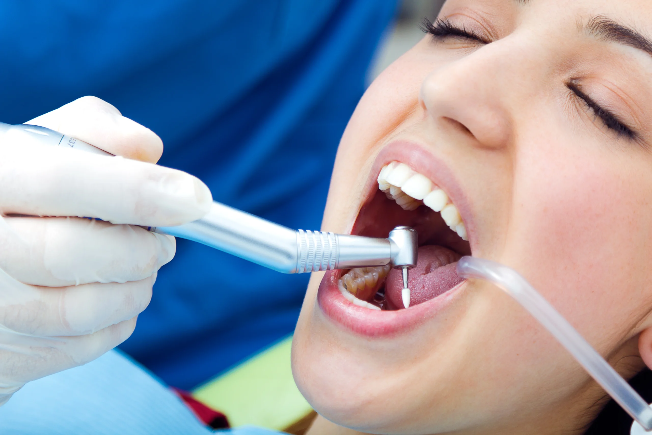 Teeth Cleaning Price in Sri Lanka