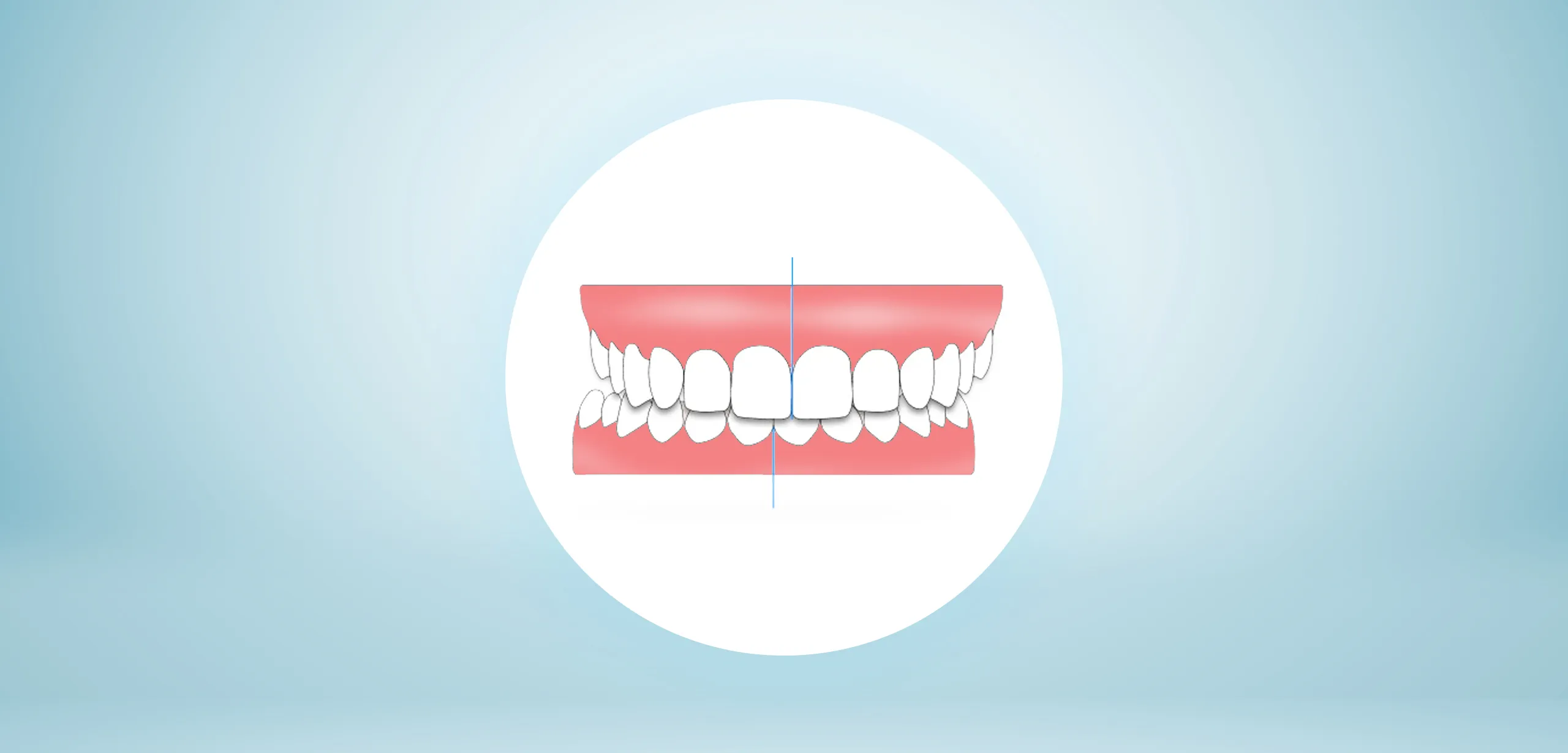 cayo-dental-clear-aligners-midline-shift