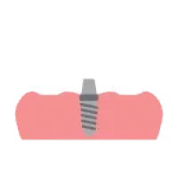 cayo-icon-dental-implant-4